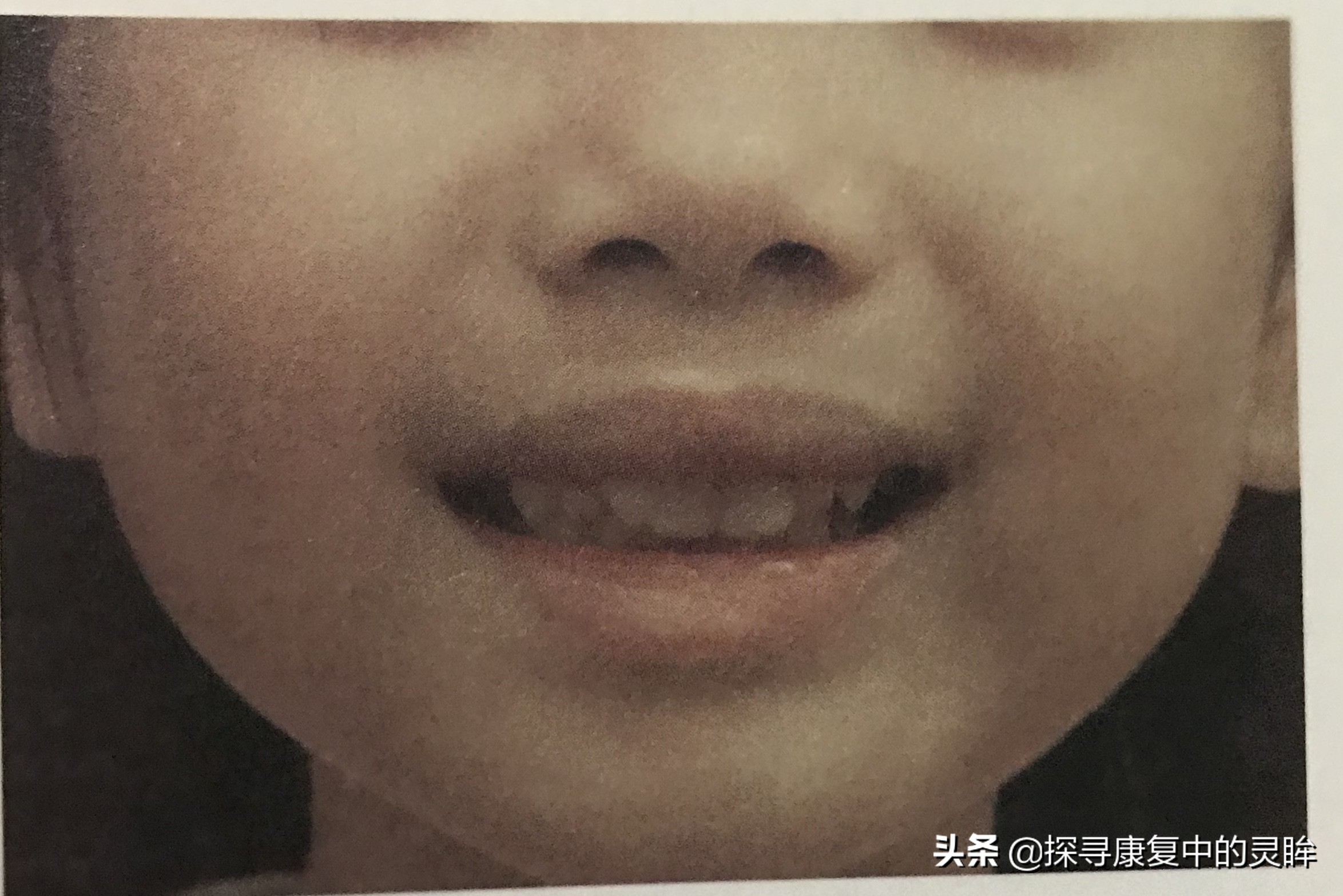 五种口部运动:灵活孩子的樱桃小嘴,让他们说话更清晰(超简单)