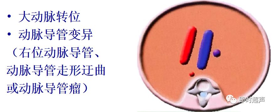 胎儿心脏三种血管关系模式图,25周的胎儿心脏弓切面多少正常