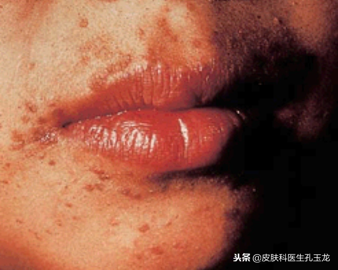 皮肤科疣状症怎么治,皮肤科医院如何治扁平疣