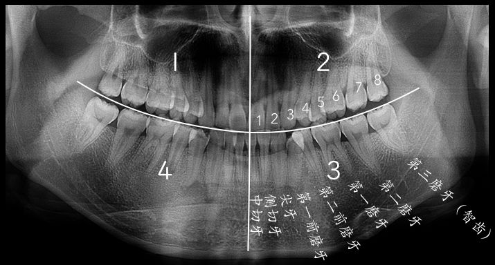 智齿拔除的价格和费用标准,拔正常智齿收费标准图