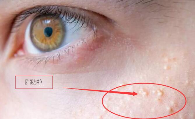 什么眼霜不长脂肪粒最好,雅诗兰黛眼霜长脂肪粒