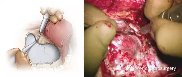 翼点入路技巧图解,翼点入路的开颅要点