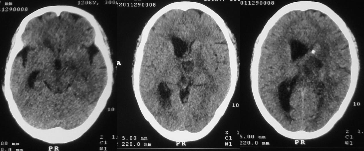 脑脓肿合并脑膜炎需要手术吗,脑脓肿进入左侧脑室严重吗