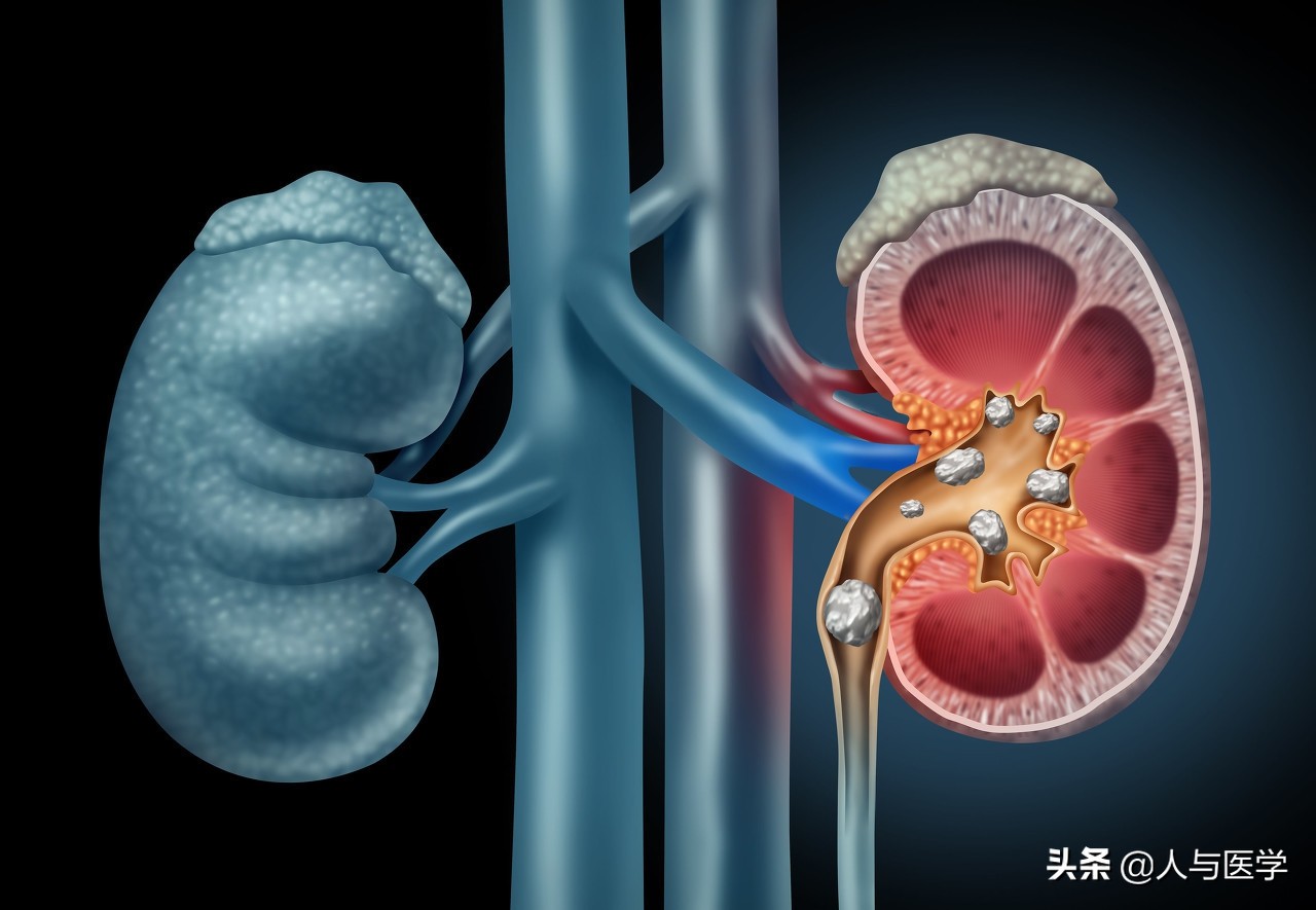 痛风久治不愈吃什么药,痛风久治不愈怎么办