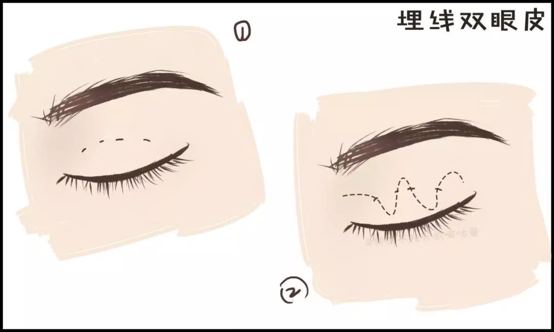 割双眼皮术前术后对比图,割双眼皮术前需要注意事项
