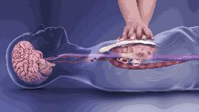 人手必备急救常识之心肺复苏术,急救技术心肺复苏术操作教学视频