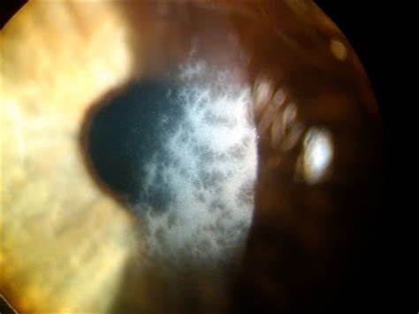 低度近视为什么不介意做近视手术,低度近视不手术还能恢复吗