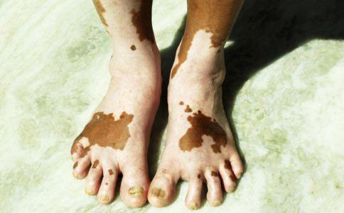 长了白斑怎么治疗,脚上长白斑是怎么回事