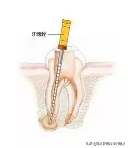 “根管不通”是怎么回事？