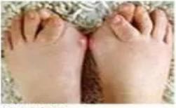 拇外翻陈医生,骨科陈医生治脚后跟疼痛