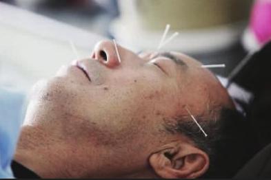 中风后流口水针灸穴位,中风偏瘫中医针灸要多久才能恢复