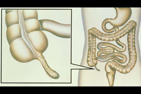 阑尾切除手术费用多少钱,阑尾切除手术记录模板