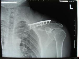 锁骨骨折为啥有人恢复快有人慢,锁骨骨折十大后遗症