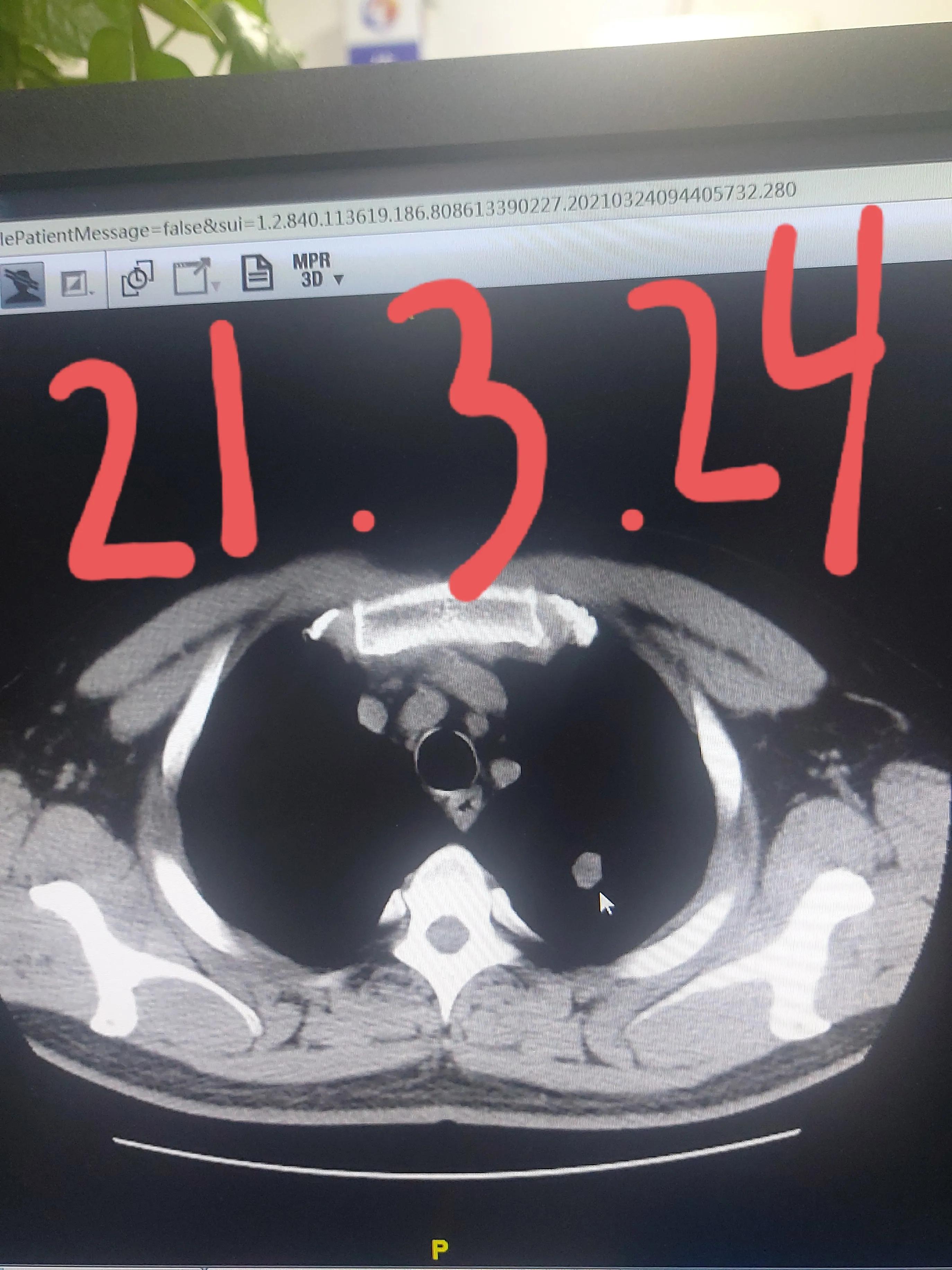 刘懿博士肺癌治疗,刘懿博士说肺癌晚期合并脑梗