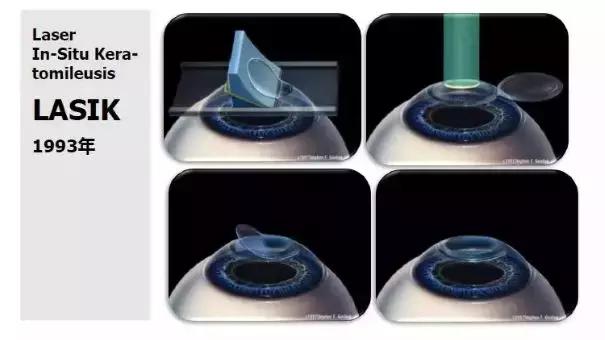 目前矫正近视手术全飞秒和半飞秒,近视眼手术全飞秒半飞秒怎么选择