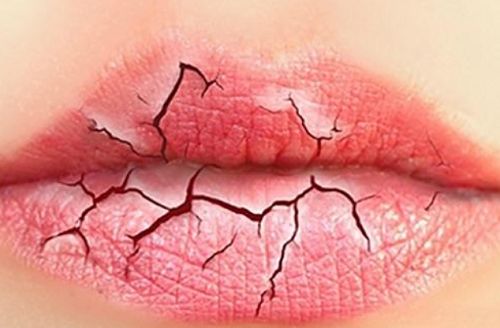 舔舔舔！唇炎找上门来怎么办？！