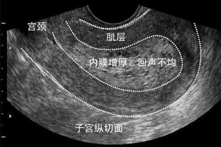子宫内膜增厚20厘米能怀孕吗,子宫内膜增厚14mm可以怀孕吗