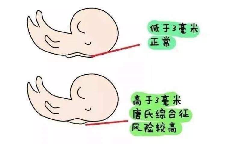 产前风险评估有必要做吗,孕妇产前筛查高危情况有哪些