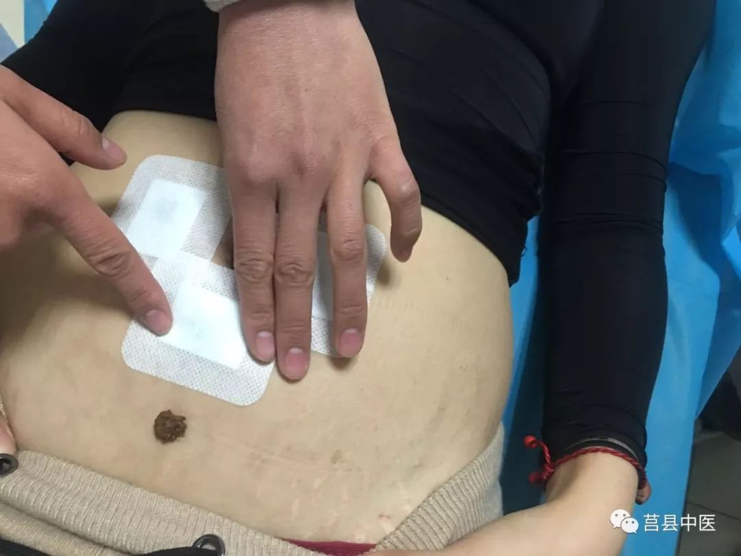 「日照莒县中医院」冬病冬治三九贴