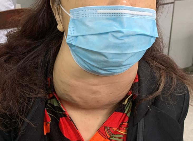 汕大附一心外科,甲亢微创手术全过程汕头