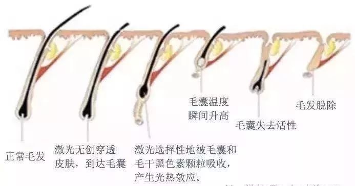 脱毛激光,脱毛各种方式比较