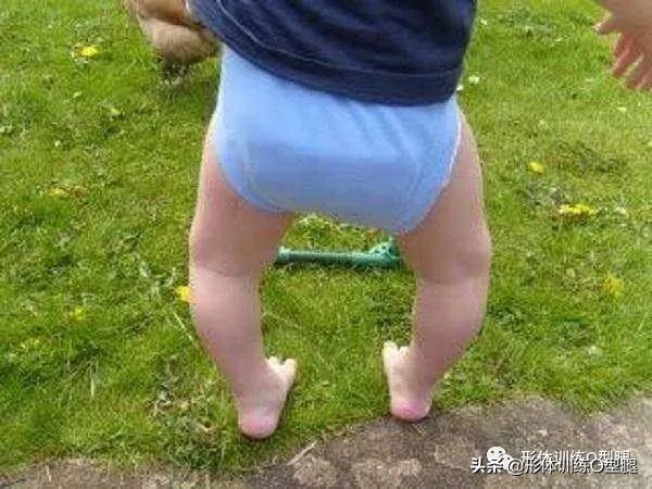 o型腿和罗圈腿图片对比,o型腿和罗圈腿的区别