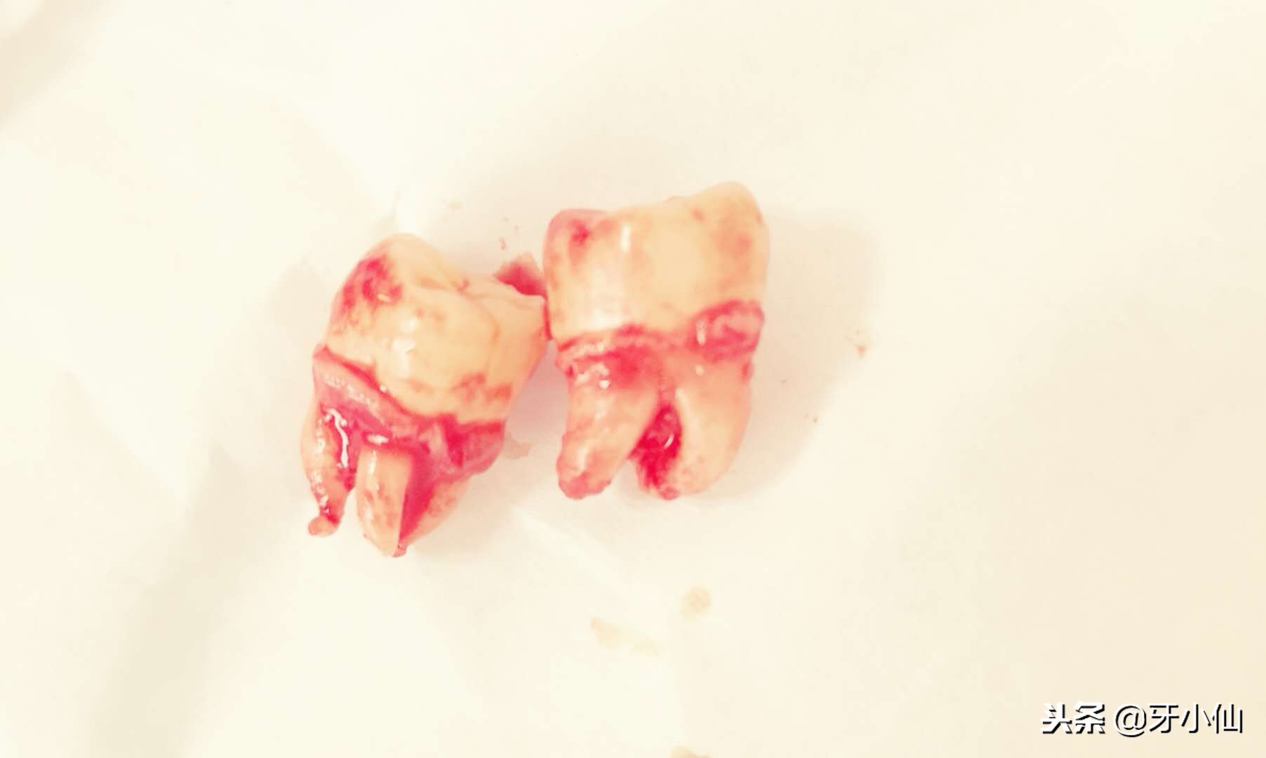 拔牙疼不过三秒,亲身经历告诉你拔牙到底痛不痛