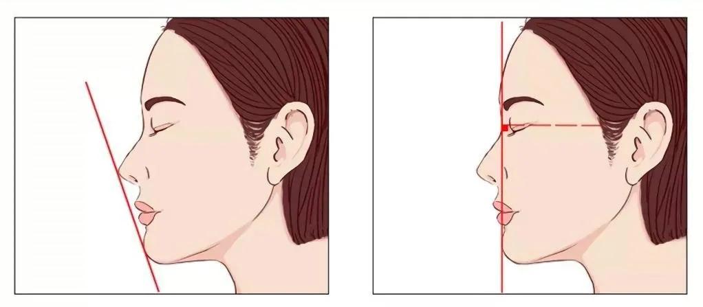 下巴短小和后缩嘴凸起好吗,下巴短小后缩但又有双下巴