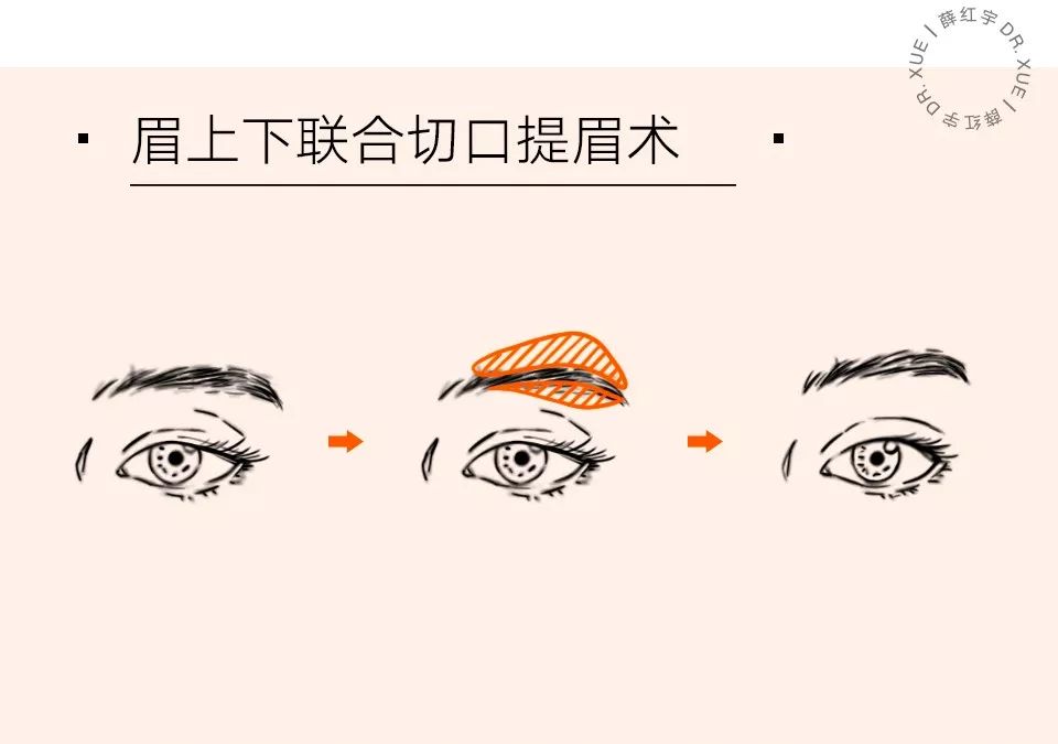 眼部抗衰最好方法,眼部抗衰效果图