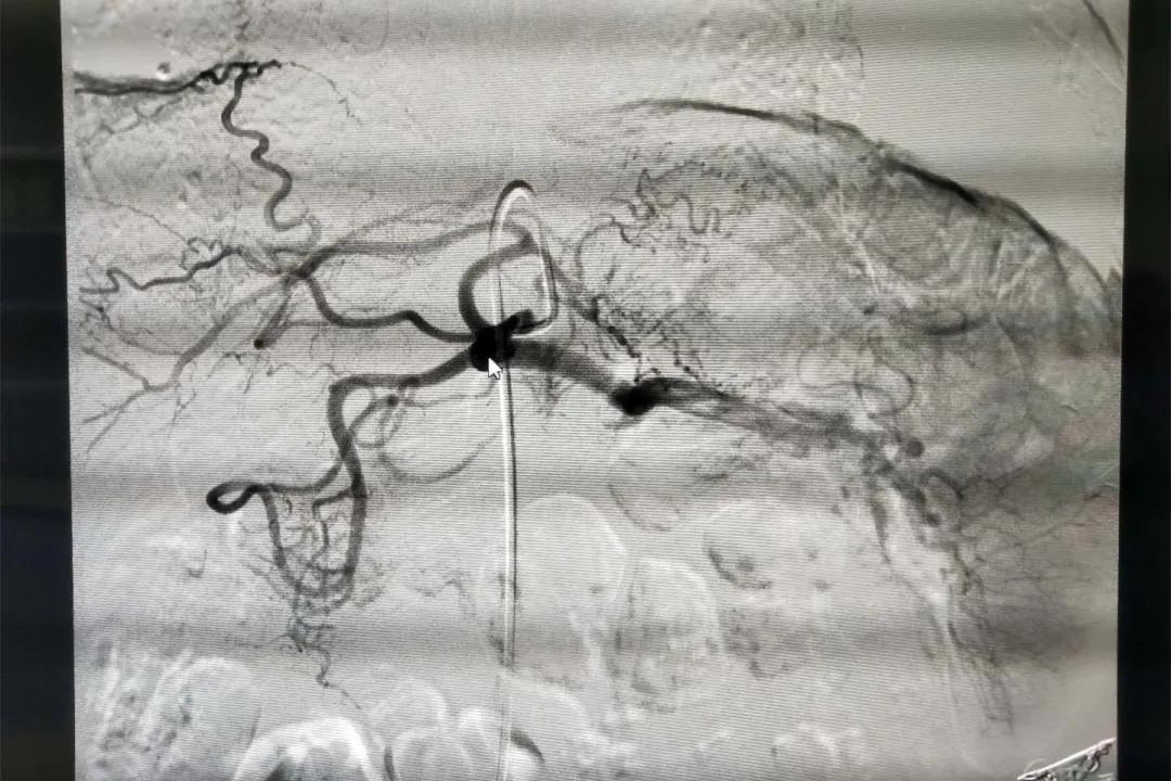 dsa动脉血管灌注栓塞术可靠吗,介入栓塞和灌注化疗