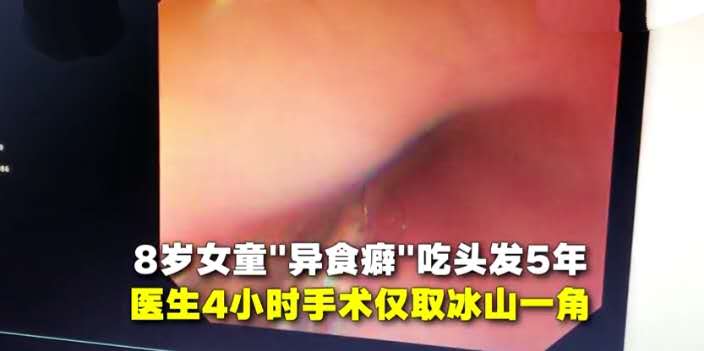 小孩误吞螺丝钉怎么办,二岁小孩误吞螺丝钉几天能拉出来