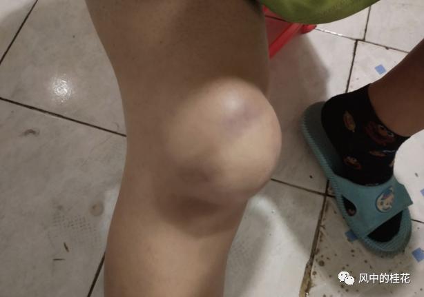 溜冰摔了膝盖关节处肿了,溜冰摔倒了膝盖不能弯曲