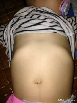 如何分辨是漏斗胸还是肋骨外翻,漏斗胸加肋骨外翻影响寿命吗