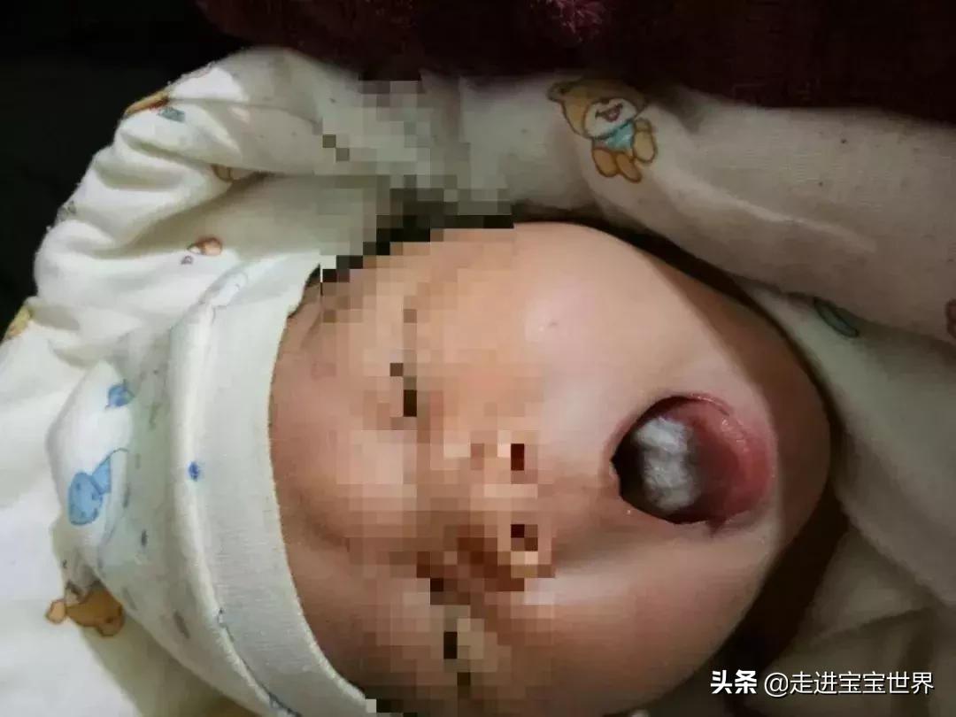 小儿积食舌苔白厚吃啥药,舌苔又厚又黄是湿气太重吗