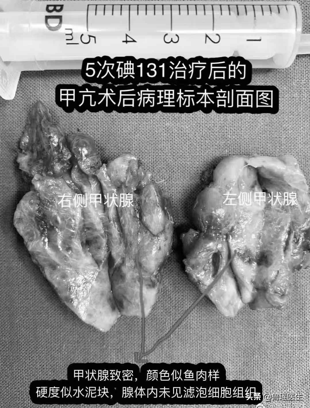 碘131治疗3次了tg值为75,碘131治疗后甲状腺功能的变化
