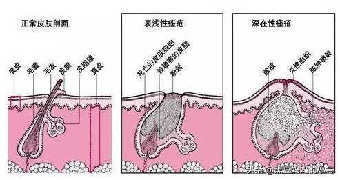 刷水杨酸对痘痘有效吗,水杨酸能不能根除痘痘