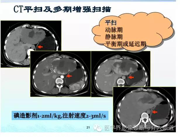 ct造影剂过敏反应及处理方法,增强ct碘过敏该用什么造影剂