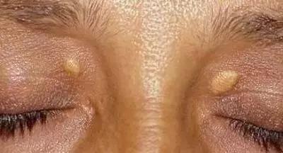 眼周长了黄疙瘩怎么办,眼周长疙瘩是怎么回事