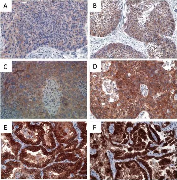 肺癌罕见突变,met14突变肺癌临床数据
