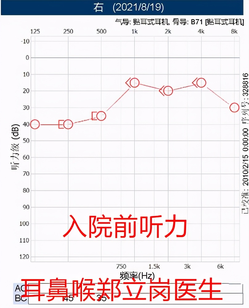 突发性听力下降是什么原因,突发性耳聋针灸后听力下降