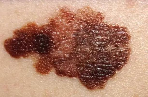 医生提醒：皮肤长出这种痣，十有八九是黑色素瘤，要及时清除！
