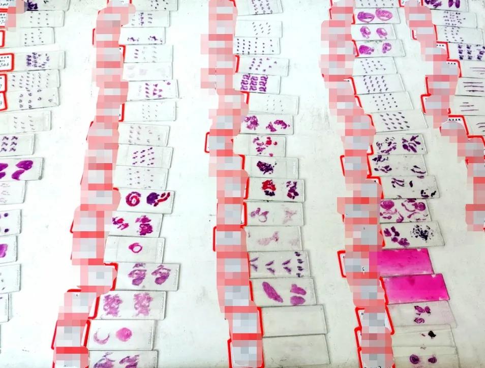 病理报告不能排除什么意思,病理报告为什么不能打印