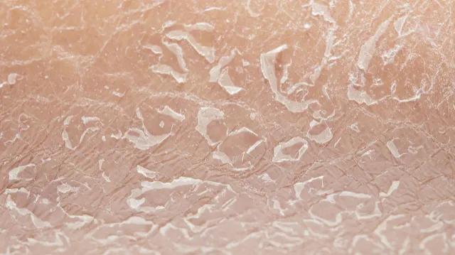 冬天腿上起白皮屑是怎么回事,冬天裤子上很多白色皮屑怎么去除