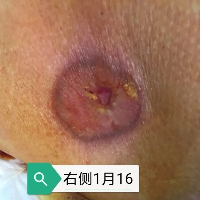 压疮的治疗成功和护理案例,压疮怎么护理好得快