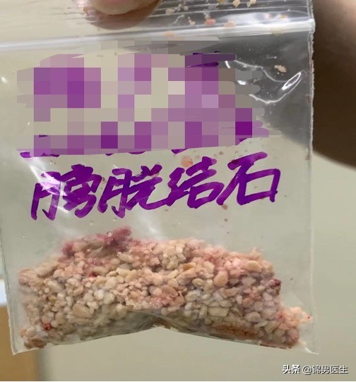 男性老年人膀胱结石怎么治疗,老年前列腺排尿困难