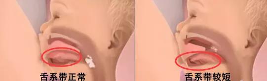 宝宝舌系带短剪了还是说话不清晰,宝宝舌系带过短剪了还是吐不出来