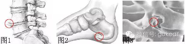 霸道“骨质增生”究竟是谁？又是如何恋上我们的？