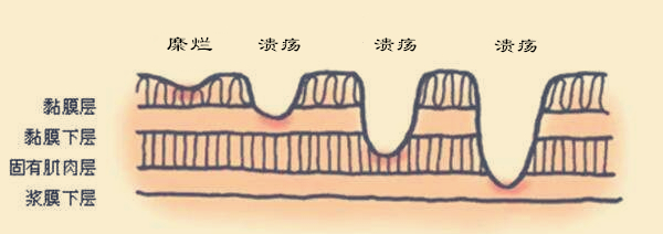 胃糜烂吃药一直不好,胃里有糜烂是怎么回事