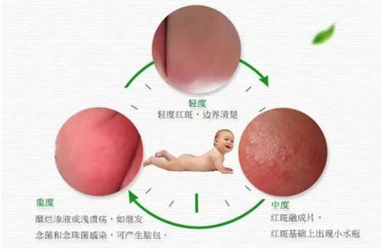 恼人的红屁屁怎么让它远离宝宝呢,预防宝宝红屁屁记住这七字诀