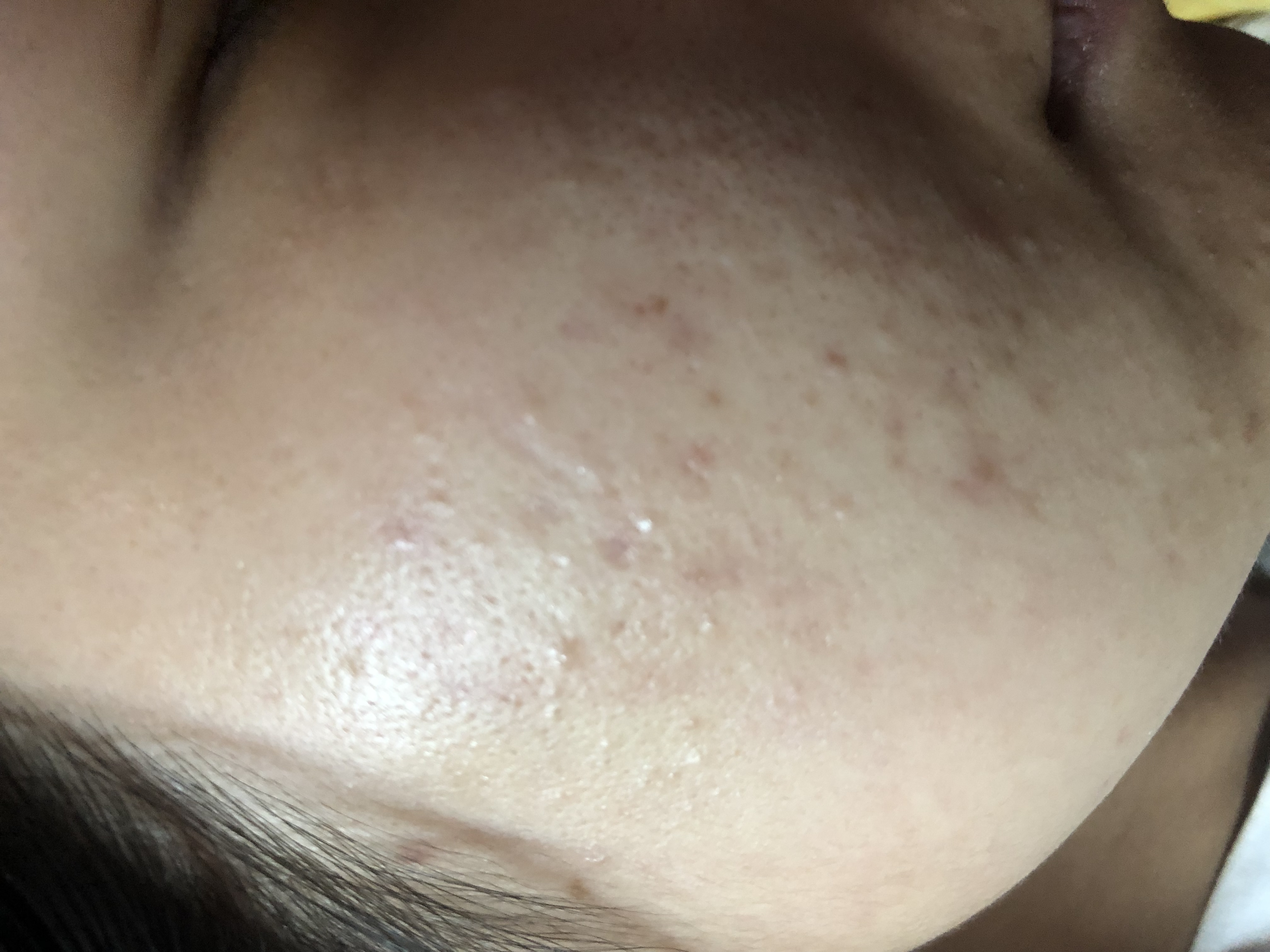 长痘烂脸期怎么修复,神仙水和海蓝之谜精华